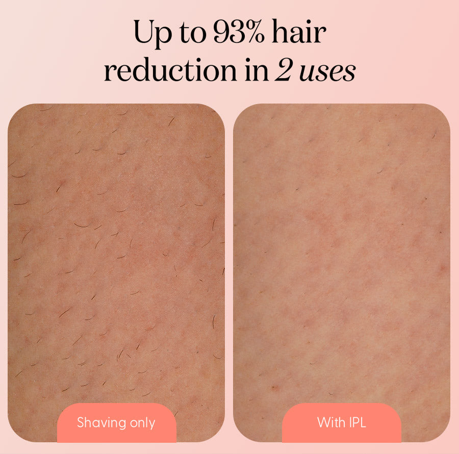 2. You'll See Dramatic Results After Just 2 Treatments (Not 12)